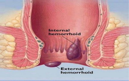 Геморрой - симптомы, лечение, причины и профилактика геморроя - Гармония